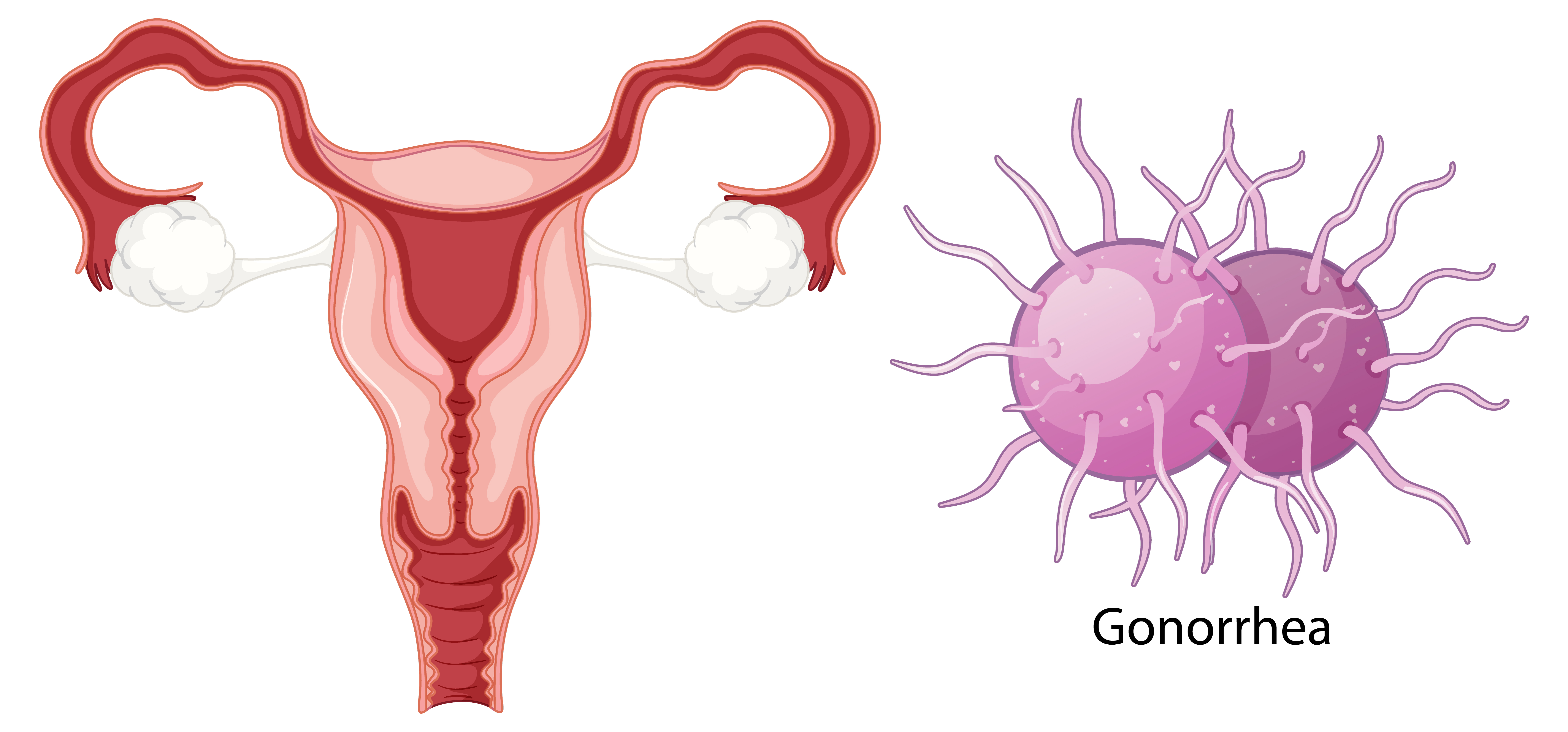 Health and Wellness Tips: Diet and Gonorrhea