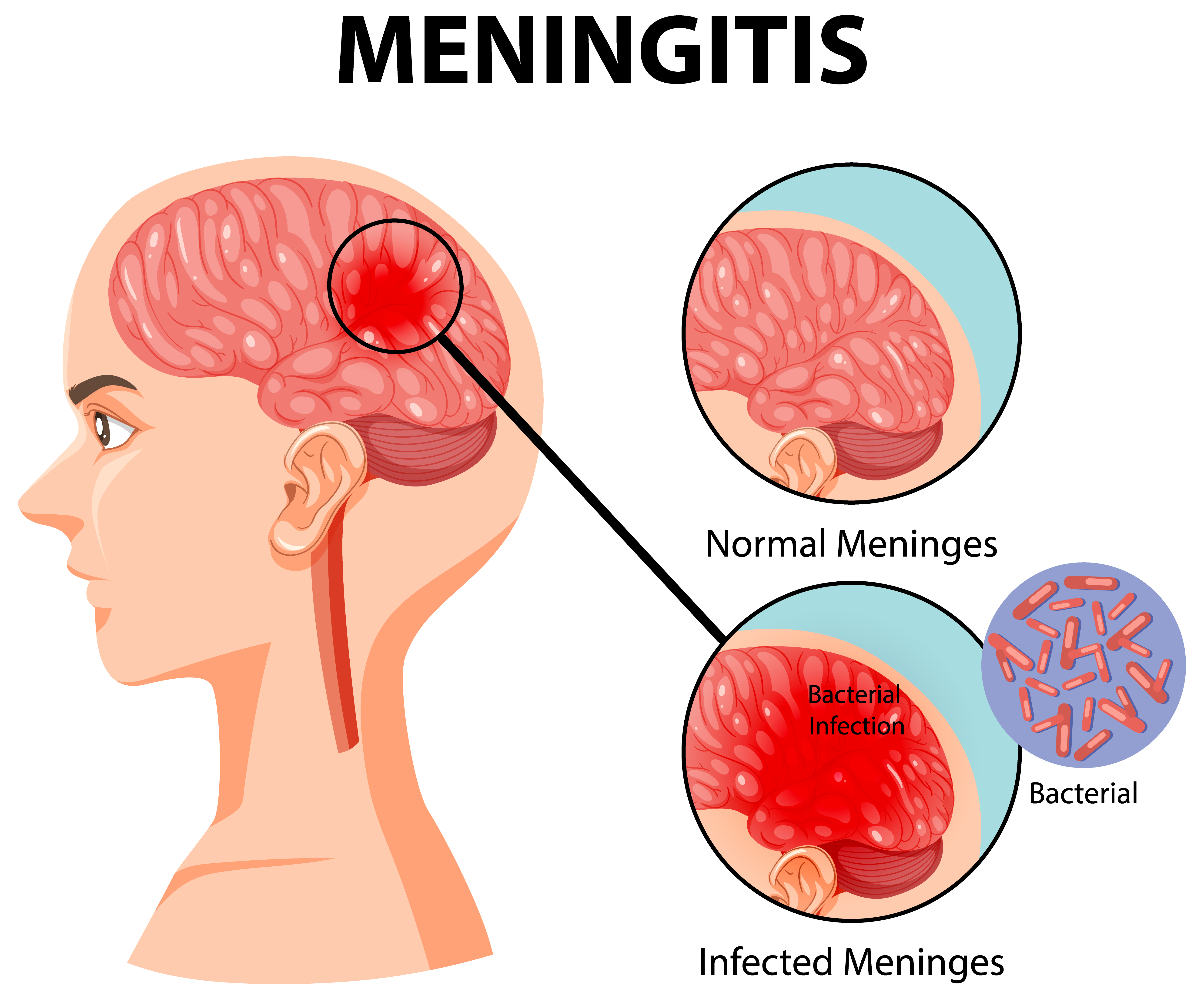 Nurturing Your Meninges: Essential Health and Wellness Tips